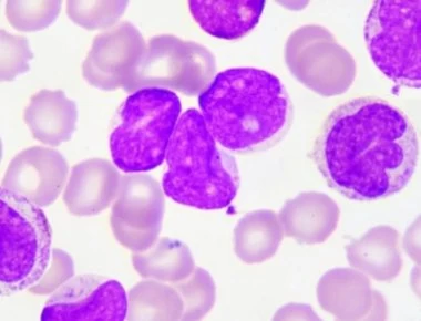 Λευχαιμία- λέμφωμα: Ποιες είναι οι διαφορές- Τι πρέπει να ξέρετε